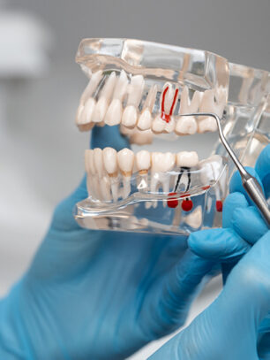 How Long Does It Take a Root Canal to Heal? What to Expect