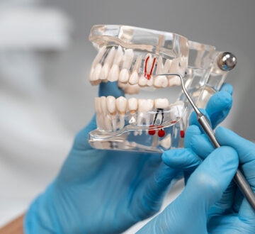 How Long Does It Take a Root Canal to Heal? What to Expect