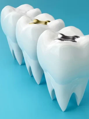 How-Dental-Fillings-Protect-Your-Teeth-From-Bigger-Problems
