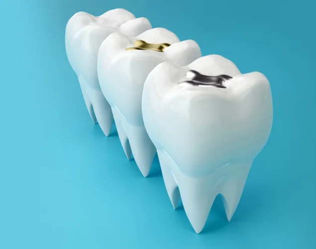 How-Dental-Fillings-Protect-Your-Teeth-From-Bigger-Problems